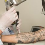 Das Bild zeigt eine Szene aus einer professionellen Tattooentfernung. Ein Arzt oder Spezialist in weißem Kittel behandelt den tätowierten Unterarm eines Patienten mit einem modernen Lasergerät. Der Patient sitzt ruhig, während der Behandler den Laser präzise auf das Tattoo ansetzt. Die Tätowierung zeigt detaillierte Schriftzüge und Motive, die durch die Lasertechnologie schrittweise entfernt werden sollen. Diese Behandlungsmethode demonstriert die Effektivität moderner Lasersysteme, die in Kliniken wie Dermacare eingesetzt werden. Solche Tattooentfernung Vorher-Nachher Bilder dokumentieren den Fortschritt und die Erfolgsaussichten der Behandlung.