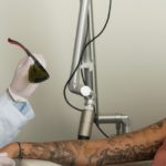 Tattooentfernung bei Dermacare