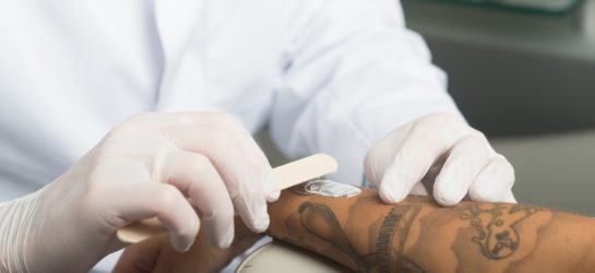 Tattooentfernung mit Picolaser bei Dermacare