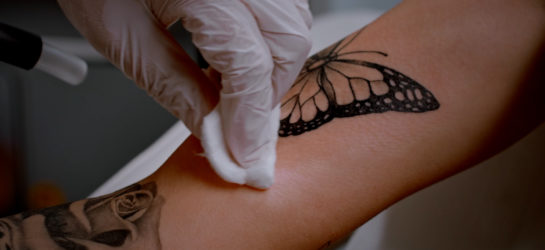 Tattooentfernung mit Laser bei Dermacare