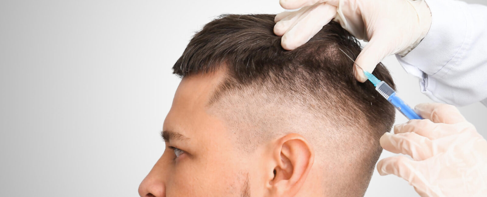 Das Bild zeigt einen Mann, der eine Haarbehandlung erhält. Ein Arzt trägt medizinische Handschuhe und injiziert eine Flüssigkeit mit einer Spritze in die Kopfhaut des Patienten, spezifisch in den Bereich des Oberkopfs, der auf Haarausfall hinweist. Diese Art der Behandlung könnte eine Eigenbluttherapie (PRP) sein, bei der Plasma aus dem eigenen Blut des Patienten in die Kopfhaut injiziert wird, um das Haarwachstum anzuregen. Die Behandlung wird bei Dermacare Wien angeboten, einem führenden Anbieter für ästhetische Behandlungen, einschließlich Haartransplantation Wien und PRP-Therapien für Haarausfall.