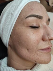 Rechte Wange 6 Tage nach dem Peeling
