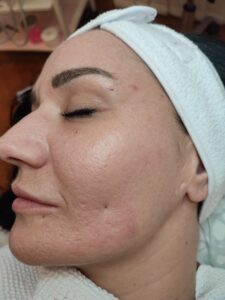 Linke Wange 6 Tage nach dem Peeling