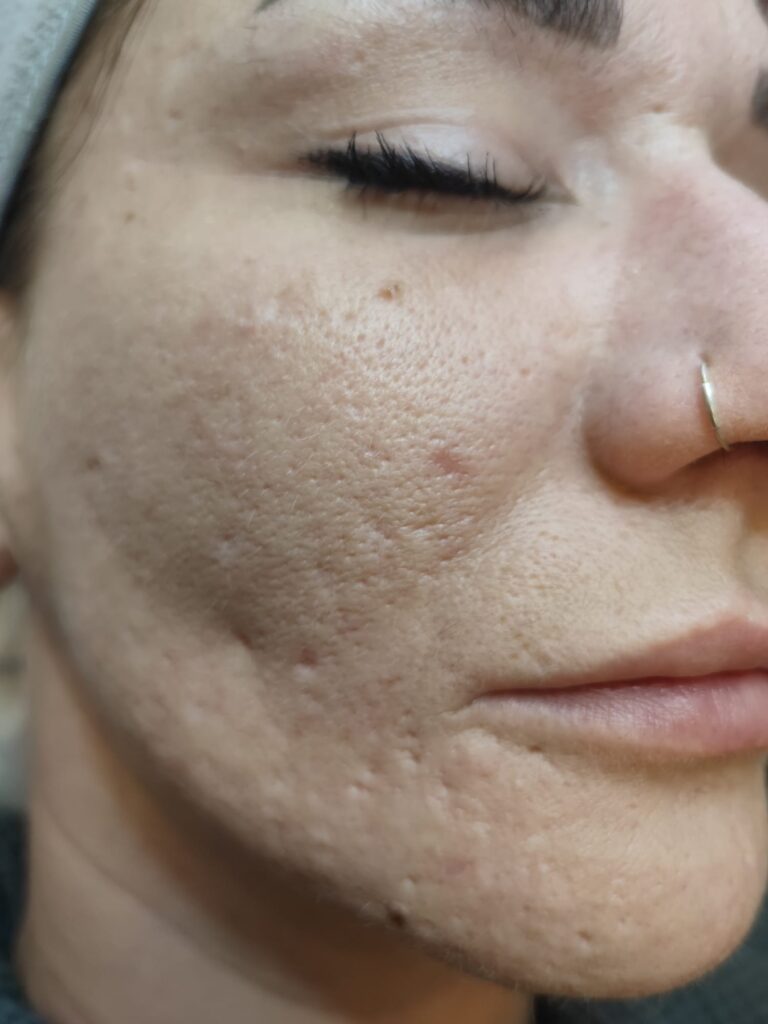 Rechte Wange vor dem Peeling