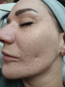 Linke Wange vor dem Peeling