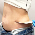 Das bild steht für Kryolipolyse Kosten und Behandlungsablauf. Hier sieht man genau genommen die Vorbereitungen zur Behandlung. Eine frau steht mit hochgerolltem top vor seitlich vor der Kamera. mit einer CoolSculpting Schablone wird ihren Bauchfett gemessen.