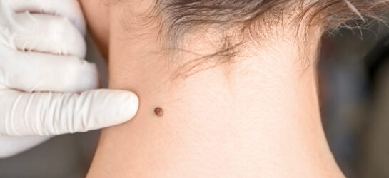 Das Bild zeigt eine dermatologische Untersuchung eines Muttermals am Hals. Eine Fachperson trägt medizinische Handschuhe und prüft die Hautveränderung sorgfältig auf mögliche Auffälligkeiten. Solche Kontrollen sind wichtig, um Hautveränderungen frühzeitig zu erkennen und bei Bedarf medizinisch zu behandeln. Bei Dermacare Wien erfolgt das Entfernen von Hautveränderungen wie Muttermalen, Warzen oder anderen Hautwucherungen unter sterilen Bedingungen und mit modernster Technologie. Dadurch wird eine präzise, sichere und narbenarme Behandlung gewährleistet – für eine gesunde und ebenmäßige Haut.