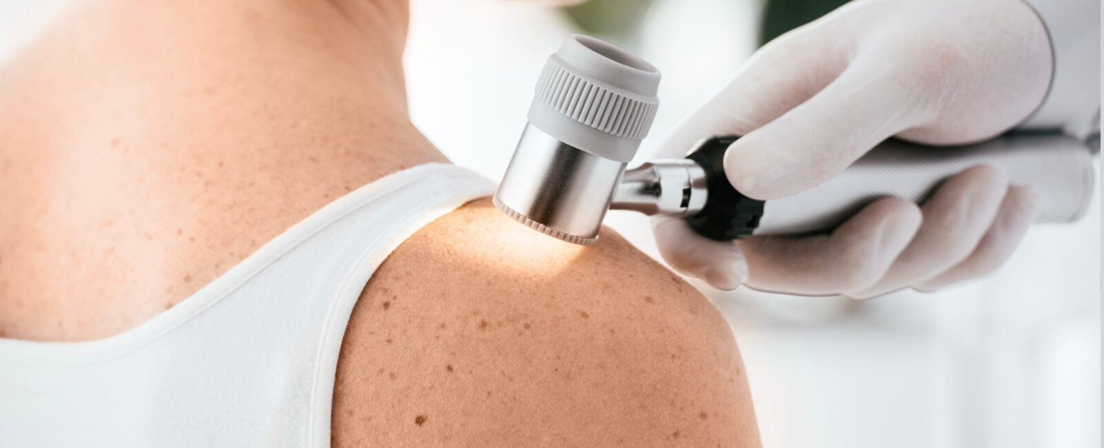 Auf dem Bild ist eine professionelle dermatologische Untersuchung zu sehen. Ein medizinischer Facharzt untersucht mit einem modernen Dermatoskop die Haut am Schulterbereich einer Patientin. Diese Art von Untersuchung wird in dermatologischen Fachzentren wie Dermacare Wien durchgeführt, um Hautveränderungen gründlich zu analysieren und mögliche Ursachen abzuklären. Dazu zählen unter anderem Hautirritationen, Muttermale oder Pilzerkrankungen, die eine präzise Diagnose und gezielte Behandlung erfordern. Das Bild vermittelt eine sorgfältige und vertrauensvolle medizinische Betreuung mit Fokus auf Hautgesundheit.