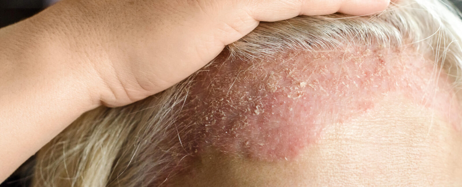 Das Bild zeigt eine gereizte, gerötete Kopfhaut mit sichtbaren Hautschuppen – typische Anzeichen für seborrhoische Ekzeme. Diese Hauterkrankung tritt häufig an talgdrüsenreichen Bereichen wie der Kopfhaut, Stirn oder im Gesicht auf und führt zu schuppender Haut, Rötungen und Juckreiz. Bei Dermacare Wien werden seborrhoische Ekzeme professionell diagnostiziert und individuell behandelt. Moderne dermatologische Therapien helfen, die Entzündung zu lindern, die Hautbarriere zu stärken und das Hautbild nachhaltig zu verbessern.