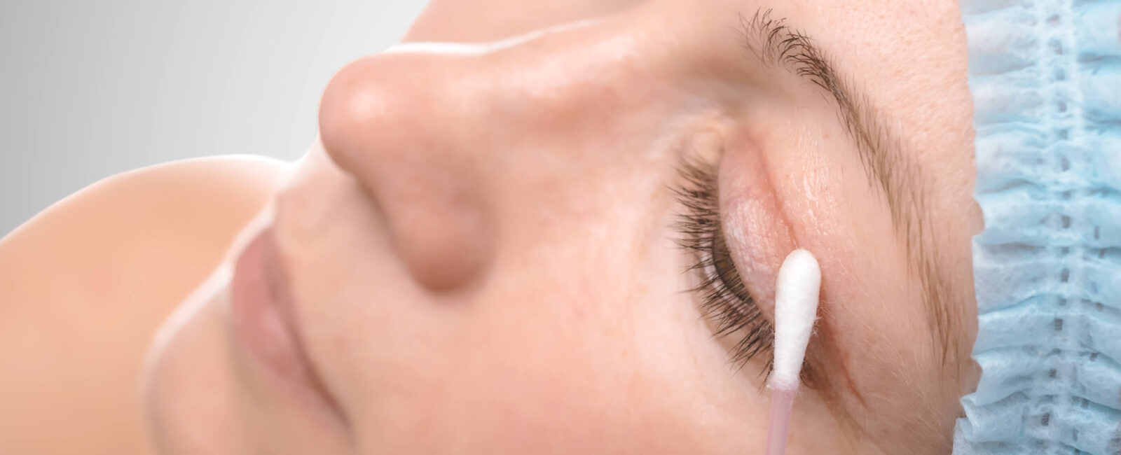 Die Frau ist gerade bereit eine operative Oberlidstraffung bei Dermacare Wien durchzuführen. Man sieht nur ihr gesicht und wie ihr Oberlid sanft mit einer Ohrstäbchen berührt wird, dort wo das Lid ganz leicht operativ behandelt werden soll.