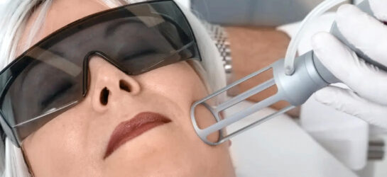 Auf diesem Bild sieht man wie Dermacare Wien einer Patientin aknenarben entfernen. Sie nutzen dabei einen hochmodernen Laser der an der betroffenen Stelle eingesetzt wird.